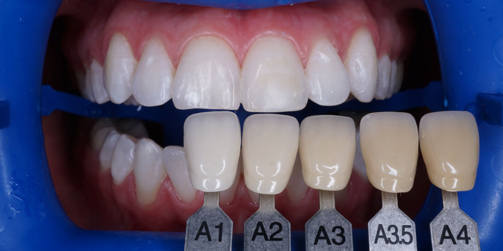  Результат профессионального отбеливания зубов системой ZOOM 4