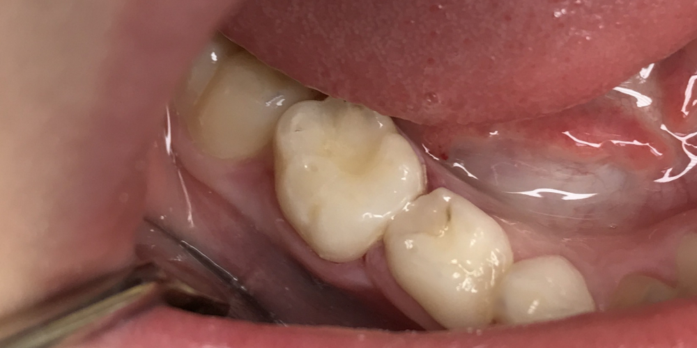  Средний кариес зуба 85 на контактной и жевательной поверхностях