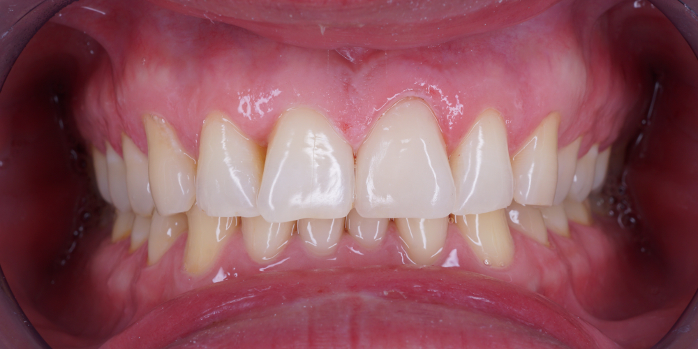  Изготовление винира на 1 центральный зуб верхней челюсти