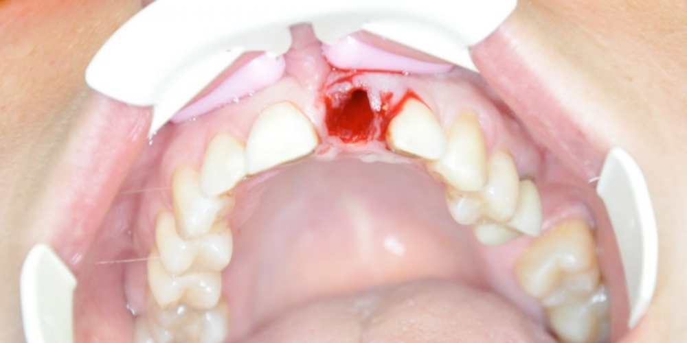 Лунка после удаления зуба Результат установки имплантата AnyRidge на место переднего зуба