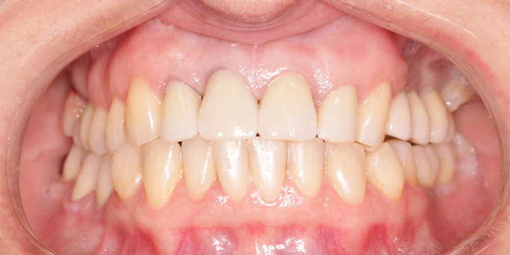  Восстановление жевательных зубов имплантацией ICX и протезированием