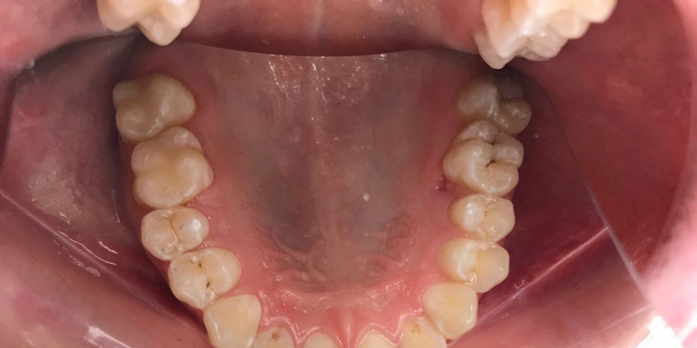  Результат лечения кариеса двух зубов