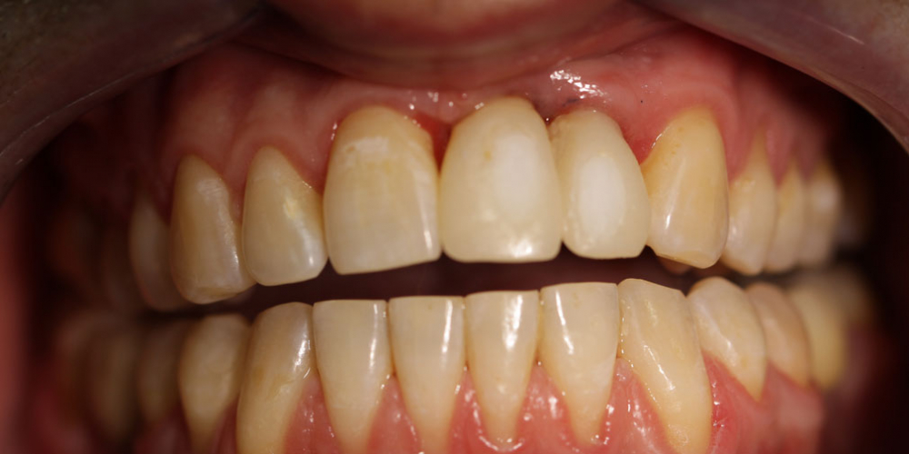  Результат имплантации и протезирования двух передних зубов