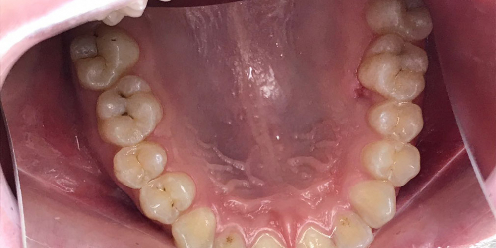  Результат лечения кариеса двух зубов