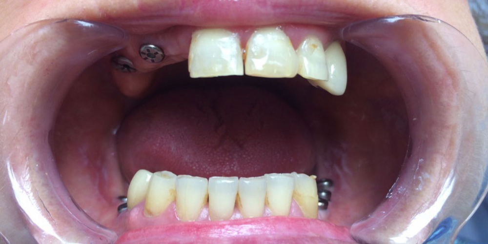  Восстановление зубов на верхней и нижней челюстях вживлением 11 имплантов