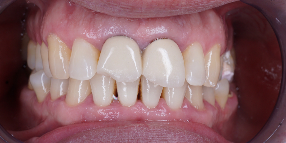  Протезирование двух зубов из диоксида циркония