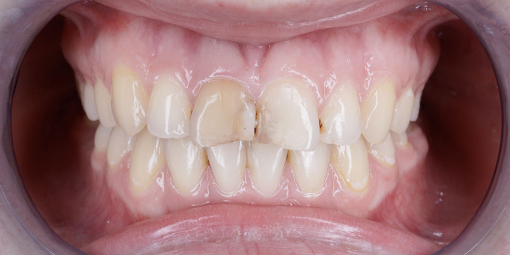 Изготовление виниров на 2 центральных зуба верхней челюсти