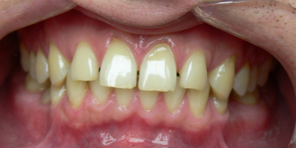  Жалобы на промежутки между зубами, не выпавшие молочные зубы на нижней челюсти