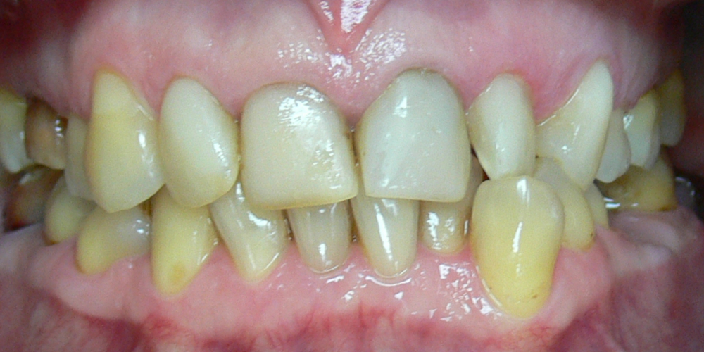  Жалобы на неровные зубы, подготовка к протезированию