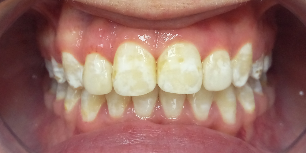  Жалобы на неровные зубы, отказ других ортодонтов ставить брекеты из-за особенности эмали (флюороз)