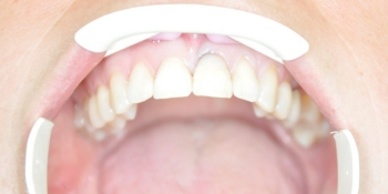 Результат установки имплантата AnyRidge на место переднего зуба фото после лечения