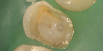Удаление стекловолоконных штифтов из зуба и распломбировка каналов фото до лечения