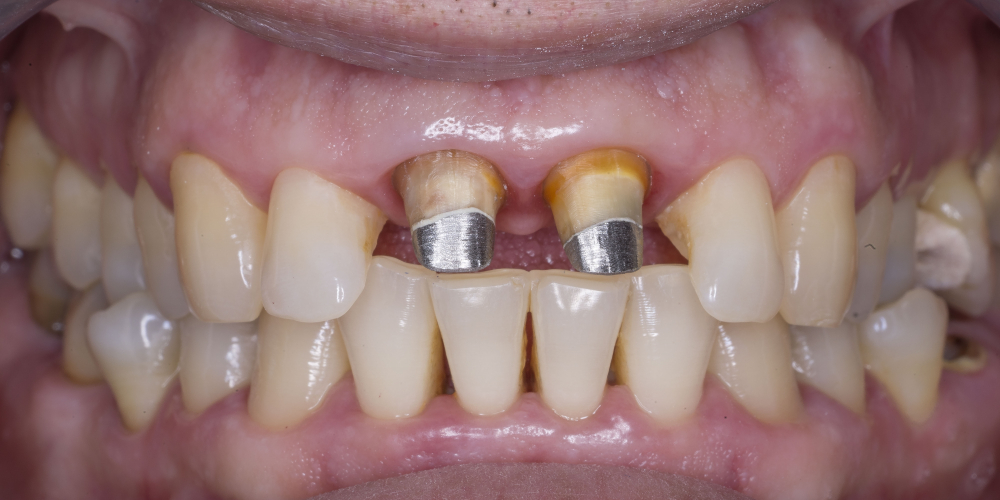  Протезирование двух зубов из диоксида циркония