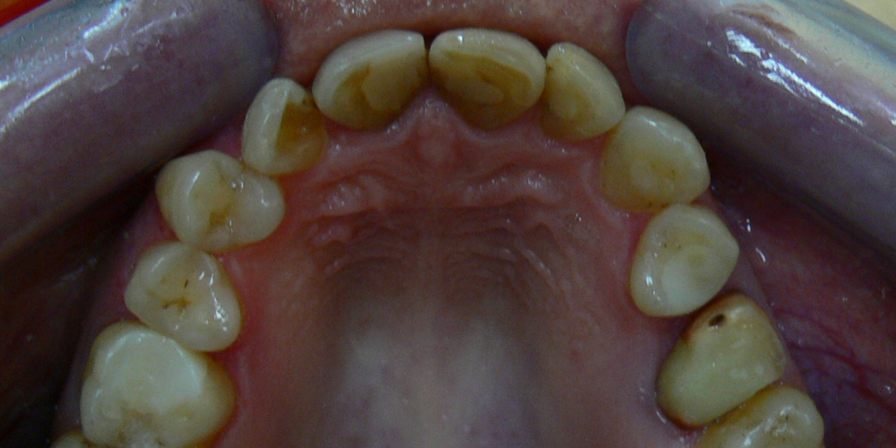  Жалобы на неровные зубы, подготовка к протезированию