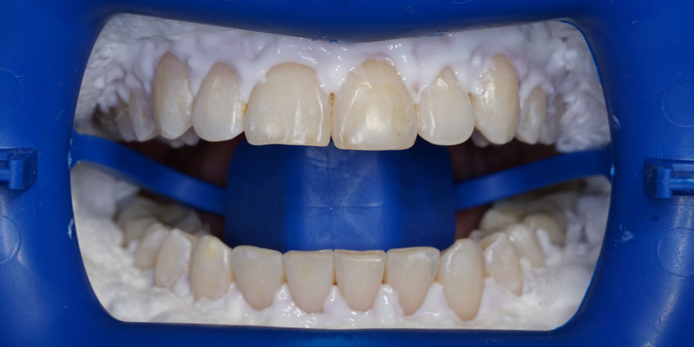  Результат профессионального отбеливания зубов системой ZOOM 4