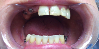 Восстановление зубов на верхней и нижней челюстях вживлением 11 имплантов фото до лечения