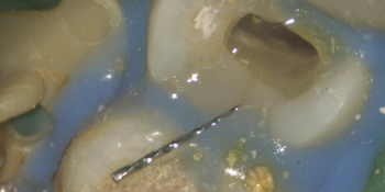 Удаление сломанного инструмента из корневого канала фото после лечения
