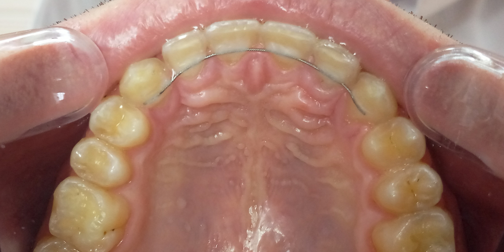  Жалобы на промежутки между зубами, не выпавшие молочные зубы на нижней челюсти