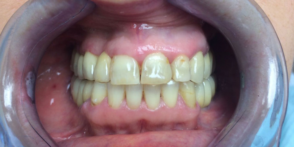  Восстановление зубов на верхней и нижней челюстях вживлением 11 имплантов