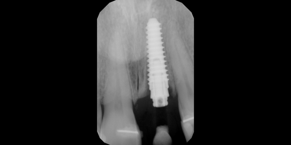 Рентген Результат установки имплантата AnyRidge на место переднего зуба